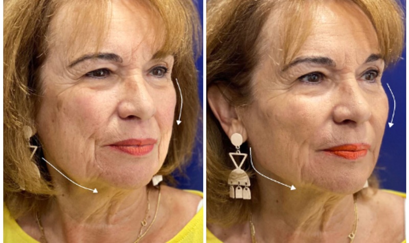 Clínica Menorca presenta su nuevo protocolo FaceUp: Voluminiza, Bioestimula y Tensa